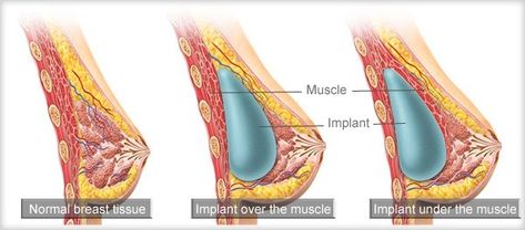 Breast implants can be placed in three distinct locations within the breast during a breast augmentation surgery. To better understand why your plastic surgeon might recommend one placement over another, read through our latest blog post. Exocrine Gland, Human Tissue, دورة شهرية, Mammary Gland, Pectoral Muscles, Breast Reconstruction, Human Body Parts, Breast Surgery, Adipose Tissue