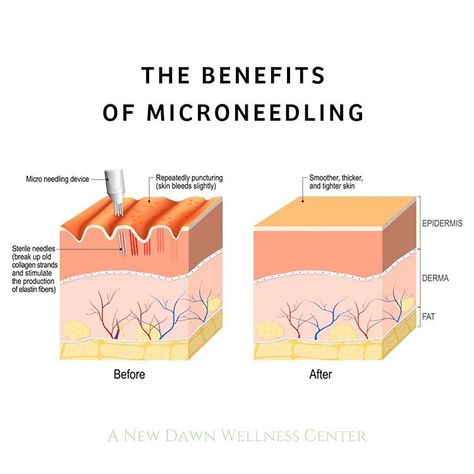 #WisdomWednesday MICRONEEDLING AT HOME - YES OR NO? Microneedling is a professional prodecure that is performed by certified aesthetic… Microneedling After Care, Microneedling Before And After, Microneedling Aesthetic, Advanced Esthetics, Certified Aesthetic, Skin Physiology, Botox Aesthetic, Microneedling At Home, Medical Esthetics