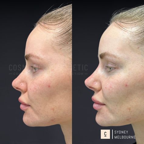 NON-SURGICAL RHINOPLASTY We offer non-surgical consultations for reshaping your nose, to address concerns such as: * A dorsal hump and bumps * Unprojected, undefined noses * Short noses * Hooked nose with a droopy tip * Round or bulbous nose tip * Ski-slope nose * High riding or retracted columella * High riding nostrils * Flaring nostrils * Crooked, bent, and deviated nose * Unsatisfactory surgical rhinoplasty result Want to know if this is an option for you? Comment 'NOSE' to claim your ... Neck Lift Surgery, Double Chin Reduction, Nose Fillers, Nose Tip, Bulbous Nose, Hooked Nose, Nose Jobs, Chin Augmentation, Nose Reshaping