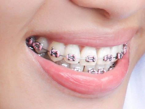 Orthodontist braces near me can be the life-changing and ensure a great smile for life. With a great smile, you get a healthier teeth and a proper bite. Ask at the dental office about a payment plan and cost of dental braces in Miami, FL. Power Chain Braces, Braces Color Wheel, Kawat Gigi, Adult Braces, Getting Braces, Kedokteran Gigi, Kesehatan Gigi, Cute Braces, Braces Colors