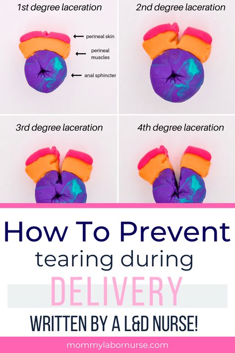 How to prevent tearing during childbirth. Learn the different degree of tears during childbirth. #childbirth #labor #delivery How To Prevent Tearing During Labor, Prevent Tearing During Birth, Prevent Tearing During Labor, Epidural Birth, Birth Advice, Perineal Tear, Natural Labor, Birth Tips, Natural Childbirth