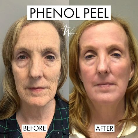 Phenol Peel Before and After Phenol Peel, Best Chemical Peel, Bad Sunburn, But At What Cost, Acid Peel, Scarring, Fat Removal, Chemical Peel, Deep Wrinkles