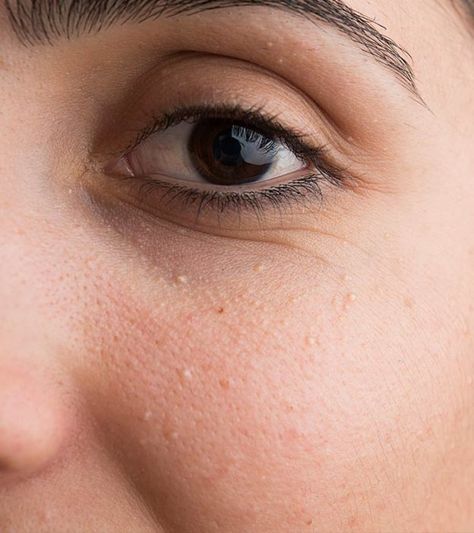 How To Get Rid Of Milia White Pimples On Face, White Bumps On Face, Eminence Organic Skin Care, Pimples On Face, Spots On Face, Skin Tightening, Skin Conditions, Eye Care, Keratin