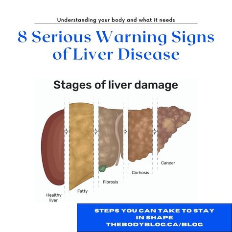 Pitting Edema, Quadrants Of The Abdomen, Enlarged Liver, Referred Pain, Kidney Detox, Get Enough Sleep, Liver Diet, Liver Failure, Healthy Lifestyle Quotes