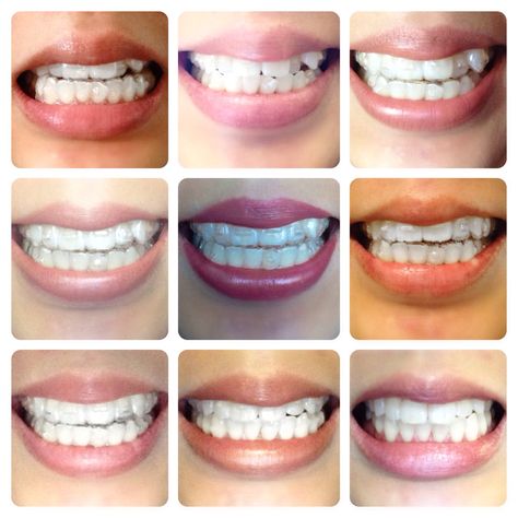 My Invisalign progress 10 months Invisalign Braces, Natural Teeth Whitening Diy, Teeth Alignment, Discolored Teeth, Partial Dentures, Charcoal Teeth Whitening, Aesthetic Dentistry, Teeth Whitening Toothpaste, Dental Braces