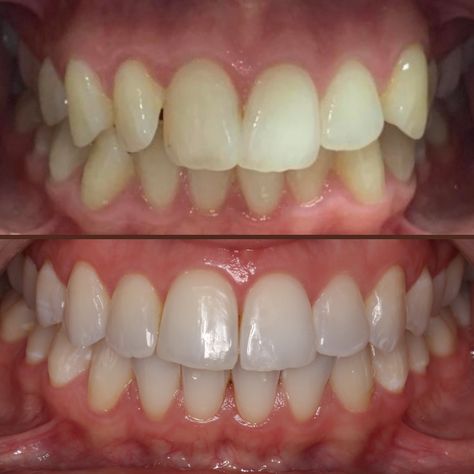 Before and after Invisalign and teeth whitening Teeth Whitening Before And After, Before And After Invisalign, Social Media Marketing Business, Marketing Business, Teeth Whitening, Media Marketing, Social Media Marketing, Social Media, Marketing