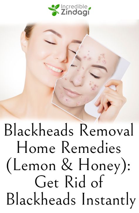 You must wash your face regularly as the blackheads still affect your skin complexion in the form of tiny black dots. Blackheads Removal, Lemon Honey, Rid Of Blackheads, Best Teeth Whitening, Get Rid Of Blackheads, Skin Complexion, Blackhead Remover, Wash Your Face, Black Dots