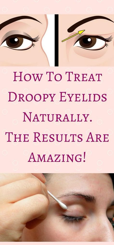 Saggy Eyelids, Droopy Eyelids, Droopy Eyes, Saggy Skin, Loose Skin, Eye Health, Skin Tightening, Beauty Treatments, Beauty Ideas