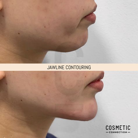 Jawline Contouring Filler, Defined Face Structure, Face Balancing Fillers, Facial Balancing Filler, Jawline Sculpting, Eye Lift Surgery, Jawline Contouring, Face Plastic Surgery, Good Jawline