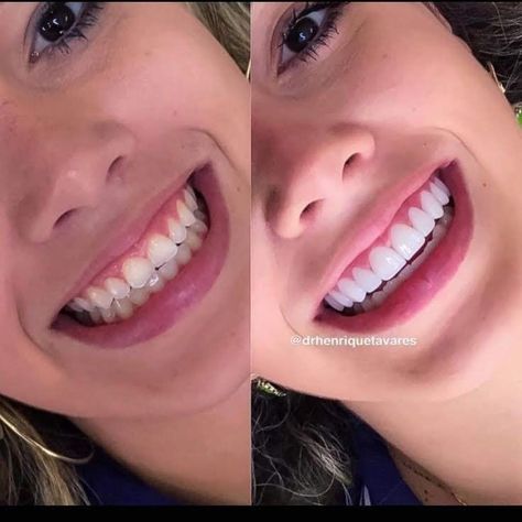 Natural Teeth Whitening Diy, Pretty Teeth, Veneers Teeth, Teeth Whitening Diy, Beautiful Teeth, Perfect Teeth, Teeth Braces, Dental Veneers, Smile Teeth