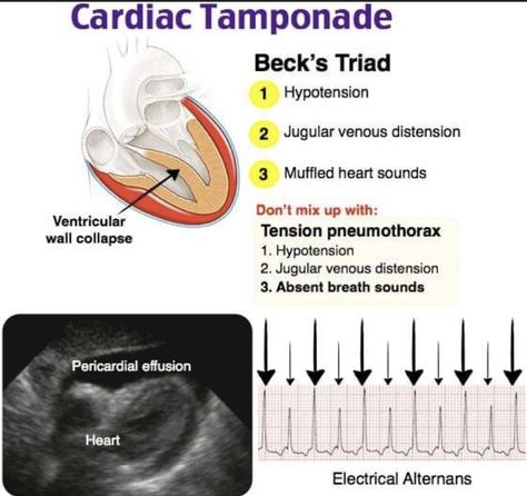 Cardiac Tamponade, Cath Lab Nursing, Diagnostic Medical Sonography Student, Cardiac Sonography, Physician Assistant School, Pericardial Effusion, Sonography Student, Diagnostic Medical Sonography, Radiology Imaging