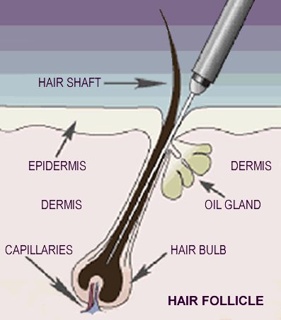 Benefits Of Microdermabrasion, Permanent Hair Removal Cream, Lauren Williams, Electrolysis Hair Removal, Medical Esthetician, Lash Training, Hair Science, Hair Facts, Yoga Information