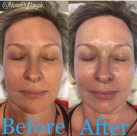 Hydra Facial Before And After, Hydrafacial Before And After, Skin Esthetics, Facial Before And After, Basic Facial, Portfolio Project, Hydra Facial, Photoshop Textures, Cosmetic Procedures