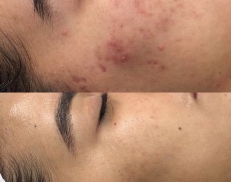 Esthetician Before And After, Skin Before After, Before And After Facial Pictures, Before And After Microneedling, Facials Before And After, Dermapen Before And After, Micronidelling Face, Microdermabrasion Before And After, Micro Needling Before And After