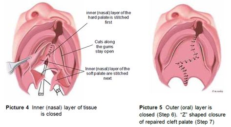 Cleft Palate Repair: The Surgery Cleft Lip And Palate, Cleft Palate, Soft Palate, Cleft Lip, Nasal Passages, Speech Language Therapy, Medical Knowledge, Medical Education, Language Therapy