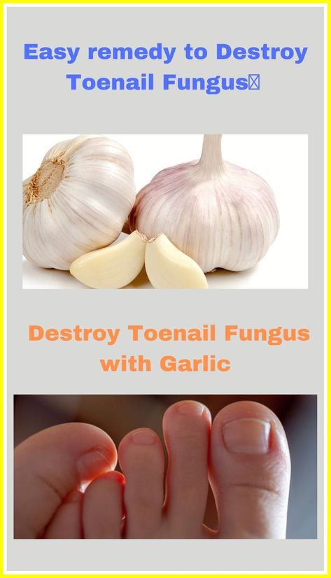 "Garlic Magic: Banish Nail Fungus with Drops of Delight!" Garlic Remedies, Toenail Fungal Infection, Nail Remedies, Fingernail Fungus, Toenail Fungus Remedies, Nail Infection, Nail Fungus Remedy, Fungal Nail, Ingrown Toe Nail