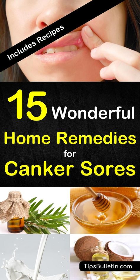 15 wonderful home remedies for canker sores. With detailed information and pictures on what causes and how to get rid of a canker sore on gums, tongue or on the lip. Includes various recipes for all stages of canker sore.#cankersore #naturalremedy #remedies Gum Sores, Canker Sore Relief, Ulcer Remedies Mouth, Canker Sore Remedy, Canker Sore, Tongue Health, Oral Care Routine, Cold Sore, Oral Health Care