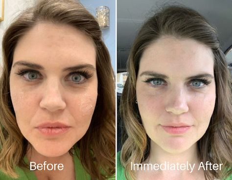 I Got Under-Eye Fillers And Here Are 5 Things To Know Under Eye Wrinkles Filler, Filler Under The Eyes, Tear Through Eye Filler, Tear Trough Remedy Natural, Eye Fillers Before And After, Eye Trough Filler Before And After, Filler Under Eyes Before And After, Undereye Filler Before And After, Tear Trough Filler Before After