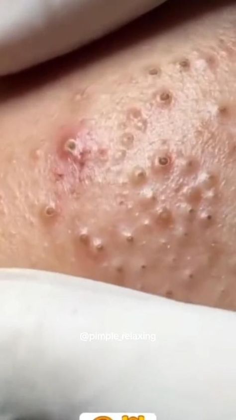 pimples popping video blackhead removal Blackheads Removal Cream, Blackhead Remover Diy, Blackhead Extraction, Clear Blackheads, Blackhead Remedies, Clear Skin Tips, Get Rid Of Blackheads, How To Get Rid Of Acne, Blackhead Remover