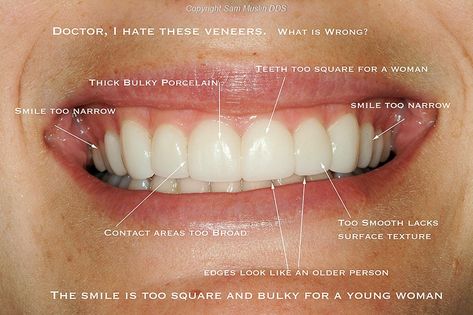 Bad Veneers - Fake-Looking and Ugly Porcelain Veneers Bad Veneers, Celebrities With Veneers, Cosmetic Dentistry Veneers, Dental Bonding, Dental Aesthetics, Veneers Teeth, Beautiful Teeth, Porcelain Veneers, Perfect Teeth