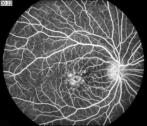 Fluorescein angiography of Stargardt's Disease, a.k.a. Juvenile Macular Degeneration. Stargardts Disease, Ophthalmic Assistant, Optician Training, Eye Nerves, Optometry School, One For Sorrow, Eye Facts, Nerve Fiber, Yag Laser