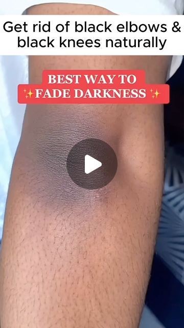 Jabeen Ki Jahan on Instagram: "Get rid of black elbows & black knees naturally   Follow @jabeen_ki_jahaan for more ❤️  #skin#skincare#trending#selflove" How To Remove Black Knees, Black Knees How To Get Rid Of, Knee Black Removal, How To Get Rid Of Black Knees, Dark Knees, Dark Elbows, Beauty Hacks Skincare, Skin Skincare, Black Knees