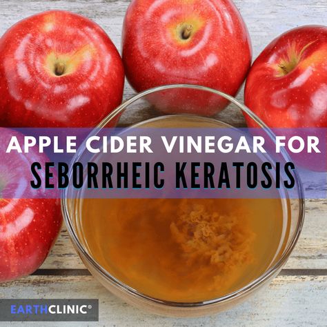 Apple Cider Vinegar for Seborrheic Keratosis Seborrheic Keratosis, Drinking Apple Cider Vinegar, Apple Cider Vinegar Remedies, Skin Moles, Apple Cider Vinegar Drink, Organic Apple Cider, Organic Apple Cider Vinegar, Nice Ideas, Homemade Beauty