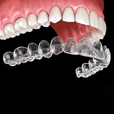 Invisalign San Diego, Cost, How it Works & Benefits Invisalign Braces, Teeth Alignment, Clear Aligners, Implant Dentistry, Say Bye, Dental Office, Your Smile, Braces, Live Lokai Bracelet