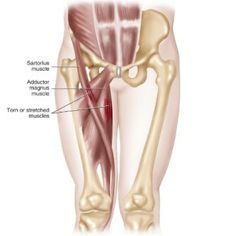 How To Treat A Pulled Thigh Muscles Muscle Tear, Sports Therapy, Health Fitness Inspiration, Muscle Anatomy, Thigh Muscles, Health Information, Pharmaceutical Industry, Health Guide, Alternative Therapies