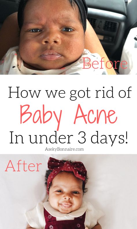 How to rid of baby acne Baby Acne Remedy, Baby Remedies, Baby Acne, Forehead Acne, Pregnancy Information, Pumping Moms, Baking Soda Shampoo, Baby Sleep Problems, Baby Skin Care