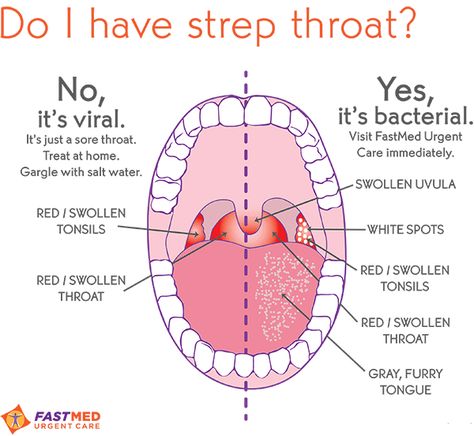 Is it strep throat or not? Good diagram explaining a viral infection vs a bacterial infection. Throat Remedies, Sore Throat And Cough, Sick Remedies, Strep Throat, I'm Sick, School Nurse, Cough Remedies, Bacterial Infection, Sore Throat