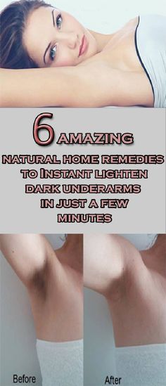 Friends here I will tell you some easy and effective home remedies to get rid of dark underarms fast. You can get rid of dark underarm in a few days by using these ingredients. Removing Dark Armpits, Dark Armpits, Underarm Odor, Unwanted Hair Growth, Underarm Hair Removal, Dark Underarms, Beauty Tips For Glowing Skin, Unwanted Hair Removal, Unwanted Hair