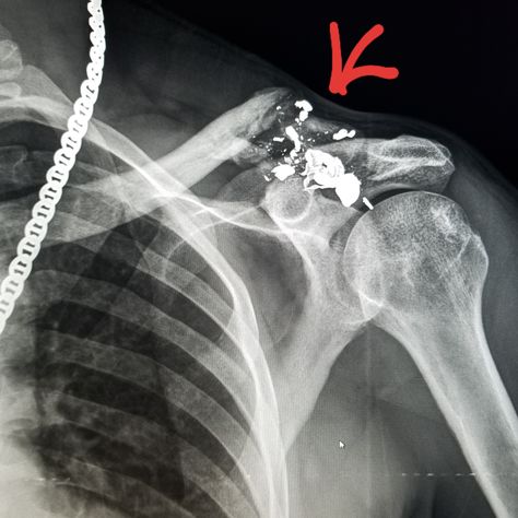 Shoulder xray: #clavicle fracture from #gun shot. #radiologist #radiology #pain #trauma #injury #gsw  This information is for educational purposes. There is no individually identifiable health information. De-identification of protected health information has been performed. Shoulder Xray, Health Information, Radiology, X Ray, Skin, Animals, Quick Saves