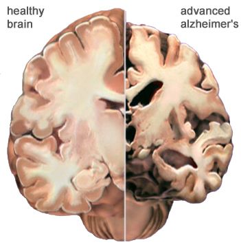 Alzheimer prevention - increase size of hippocampus.  1. Brain stimulators - wear watch on other hand, try writing or other things with opposite hand 2. Meditation - breath in 7 sec, hold 7 sec, release slowly 3. tease your memory 4. physical exercise  blood flow to brain generates new brain cells. 5. see other foods, esp DHA supplement Alzheimer's Prevention, Alzheimers Awareness, Healthy Brain, Human Brain, Alzheimers, Brain Health, Natural Health, Right Side, Disease