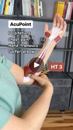 10K views · 1.1K reactions | HT 3 is located at the medial end of the cubital (elbow) crease.   We can acupuncture it, but also massage (Tui Na) along the flexor carpi radialis and pronator teres muscles on the anterior of the forearm to help relieve golfer elbow pain 🙏   This is why it’s very important to know our anatomy when we palpate the body ✅  ➡️ Cupping or Gua Sha would help relieve the golfer elbow pain too.   Of course as a He-Sea point it has lots of Qi & Blood and can help with chest pain, palpitations, hand tremors, and support manic depressive patients.   #anatomy #acupuncture #elbowpain #acupuncturepoints #acupuncturestudent | AcuPro Academy | northernelg · Formidable (@northernelg remix) Flexor Carpi Radialis, Pronator Teres, Body Cupping, Hand Tremors, Tremors Hand, Golfers Elbow, Sea Point, Elbow Pain, Acupuncture Points