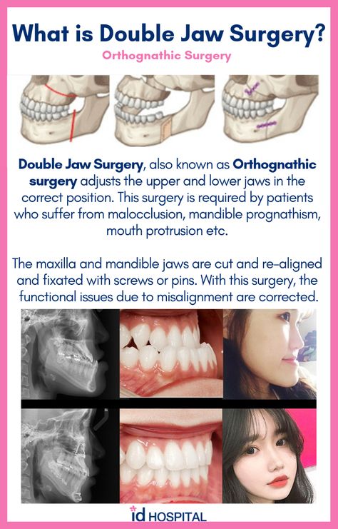 Many patients think they need double jaw surgery to get a smaller face! Orthognathic surgery is more of a functionality surgery. ID Hospital specializes in orthognathic surgeries and facial bone surgeries. Click here to find out more about this surgery! #idhospital #idhospitalkorea #plasticsurgery #koreanplasticsurgery #surgeryinkorea #facialcontouring #orthognathicsurgery #doublejawsurgery #malocclusion #mouthprotrusion #underbite #overbite #crossbite Jaw Surgery Before And After Overbite, Orthognathic Surgery Before And After, Double Jaw Surgery Before And After, Jaw Surgery Before And After, Jaw Surgery Recovery, Beauty Surgery, Double Jaw Surgery, Surgery Care Package, Mouth Hygiene