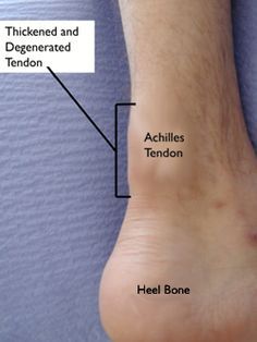 Achilles Tendon Ruptures, Achilles Tendinopathy, Achilles Pain, Swollen Knee, Soft Tissue Injury, Ankle Surgery, Achilles Tendon, Ankle Pain, Knee Exercises