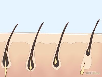 How to Get Rid of Body Hair -- via wikiHow.com How To Get Rid Of Hairy Legs, How To Remove Body Hair Naturally, How To Get Rid Of Body Hair, Hair Medicine, Natural Hair Removal Remedies, Epilating, Reduce Hair Growth, Treating Acne, Growing Healthy Hair