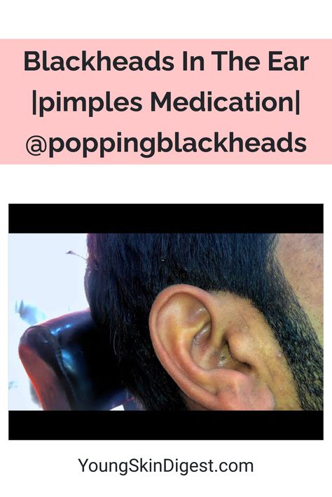 Blackheads In The Ear |pimples Medication| @poppingblackheads Ear Blackheads, Black Head Removal Video Nose, Pimple Hacks, Acne Recipes, Huge Blackheads, Ear Pimple, Inflamed Pimple, Best Acne Scar Removal, Pimple Solution