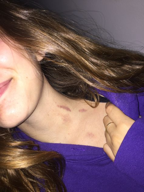 Chest Love Bites Hickey, Aesthetic Couple Hickey, Hickies Neck Aesthetic Girl, Hickies Neck Boys And Girl, Love Bites Hickey, Neck Full Of Hickeys, Love Bite Photos, Hickies Neck Aesthetic, Hickies Neck