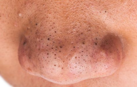 And how to keep it that way for good Remove Blackheads From Nose, Chest Acne, Blackhead Remedies, Blackhead Remover Tool, Blackheads On Nose, Get Rid Of Blackheads, Acne Remedies, How To Get Rid Of Acne, Brown Spots