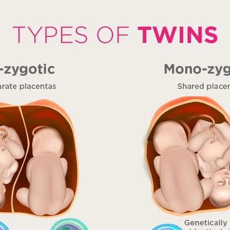 microbiologyupdate on Instagram: "TYPES OF TWINS !!! DO YOU KNOW ? 🤔🤔🤔🤔🤔🤔 There are two types of twins – identical (monozygotic) and fraternal (dizygotic). To form identical twins, one fertilised egg (ovum) splits and develops two babies with exactly the same genetic information. Such twins, known scientifically as 'MoMo', an abbreviation for monoamniotic-monochorionic, are some of the rarest types of twins, making up less than one percent of all births in the United States, noted the statement. It also stressed that such MoMo twin pregnancies have a high risk of fetal complications. Save it for future reference 😁 Share with your twin friends 😊 Thank you ❤️ . . . . . . . . #microbiologyupdate #twins #twinsbaby #monozygotic #monozygotictwins #dizygotic #dizygotictwins #ovum #fer Dizygotic Twins, Twins Identical, Twins In The Womb, Momo Twins, Types Of Twins, Twin Pictures, Conjoined Twins, Fraternal Twins, Birth Rate