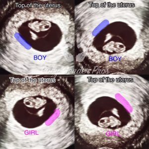 Having a boy or girl? Find out at 6 weeks!  Come find out the gender of your baby! We use Ramzi, Nub and Skull method!  www.babygenderpros.com Ramzi Theory, Vom Avea Un Copil, Baby Gender Prediction, Gender Prediction, Baby Sleep Problems, Clay Baby, Good Ideas, Pregnancy Care, Kids Discover