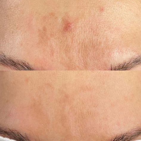 Erbium Laser Resurfacing, Fraxel Laser, Erbium Laser, Ipl Photofacial, Face Laser, Lip Lightening, Laser Skin Care, Laser Skin Resurfacing, Fractional Laser