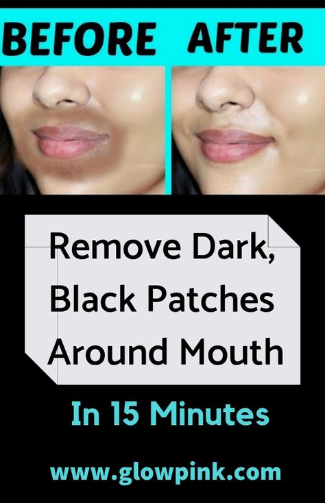 Remove Darkness Around Mouth, Hyperpigmentation Around Mouth, Darkness Around Mouth, Get Rid Of Hyperpigmentation, Mouth Lips, Lips Black, Scar Removal Cream, Glowing Skin Mask, Black Patch