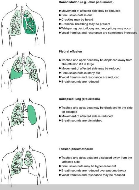 While pneumothorax may be referred to as a collapsed lung, people sometimes use the term 'collapsed lung' to refer to atelectasis. Atelectasis refers to improper amounts of air in the alveoli (air sacs), resulting in a loss of volume in all or part of the lung. This loss of air in the alveoli can be due to obstruction. Nursing Information, Nursing Assessment, Nursing Mnemonics, Pulmonology, Nursing School Survival, Respiratory Care, Respiratory Therapy, Nursing School Studying, Nursing School Notes