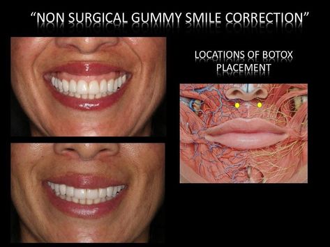 Gummy Smile Correction, Hyaluronic Pen, Aesthetic Nursing, Botox Injection Sites, Botox Cost, Botox Clinic, Botox Injection, Botox Before And After, Botox Face