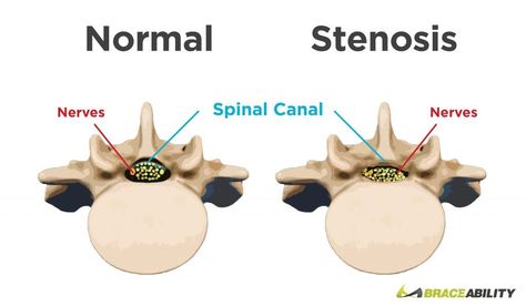 Narrowing Of The Spine, Stenosis Of The Spine, Stenosis Exercises, Spinal Fusion, Spinal Surgery, Spinal Injury, Spine Health, Sciatic Nerve Pain, Sciatic Nerve