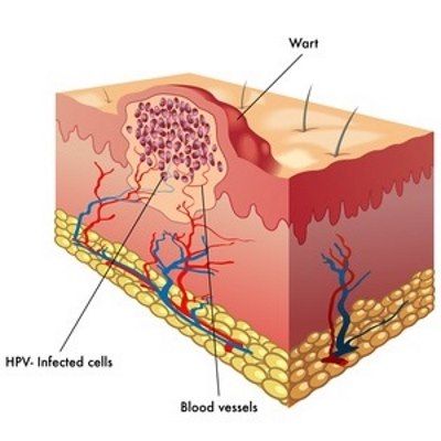 Warts on the skin are irritating, embarrassing and annoying. There are 5 different types of wart: common, plantar (feet), flat, periungual, filiform (facial) Different Types Of Warts, Filiform Wart, Types Of Warts, Teeth Whitening Remedies, Laser Clinics, Skin Clinic, Natural Home Remedies, Natural Home, Natural Treatments