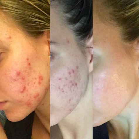 Before And After Acne, Redness Pimple, Clear Skin Fast, Skin Care Pictures, Forehead Acne, Natural Acne Remedies, How To Get Rid Of Pimples, Cystic Acne, Acne Remedies